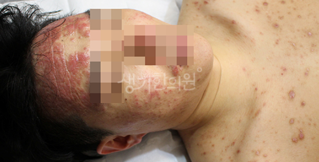 금천구피부과증상 지루성피부염 여드름과 차이점은?