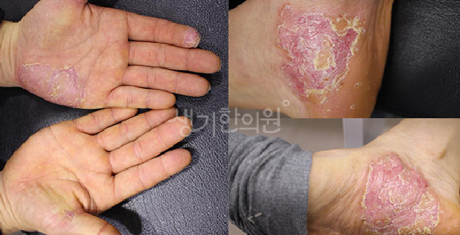 손 건선습진 차이점은?