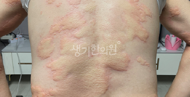 풀독 두드러기 주의사항 대처법은?