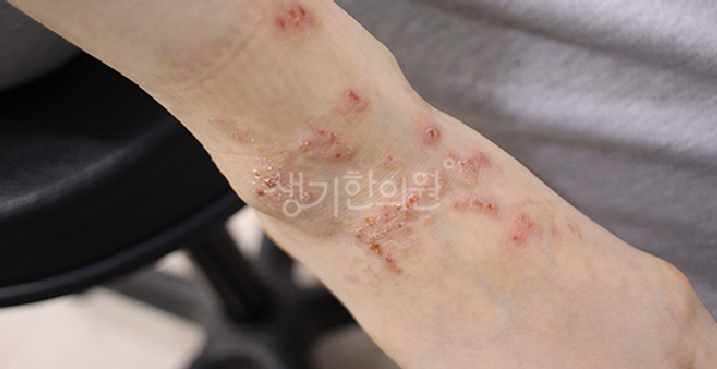 놓치기 쉬운 아토피 초기증상 3가지는?