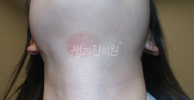 얼굴습진 연고로 누르면 더 크게 재발하는 사람? <필독>