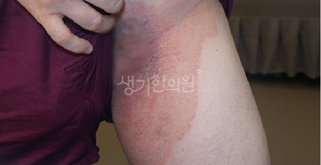 허벅지 습진 원인, 증상, 치료방법까지