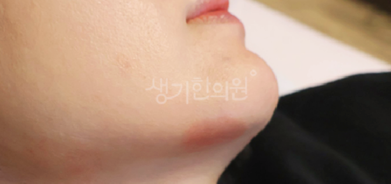 배곧지루성피부염 여름이 오기 전 치료해야 하는 이유