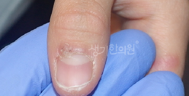 발 사마귀 냉동치료 통증 심한 케이스는 어떻게 접근해야 할까?
