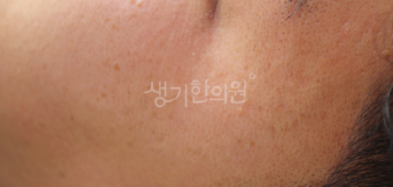 편평사마귀 간지러움 증상 외에는?