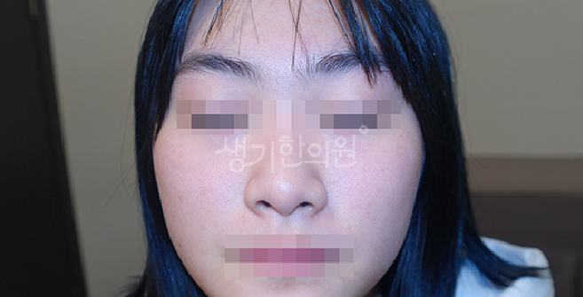 술 안면홍조 알코올 분해와 피부 붉어짐의 상관관계는?
