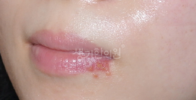 입술 단순 포진 바이러스 재발 쉬워