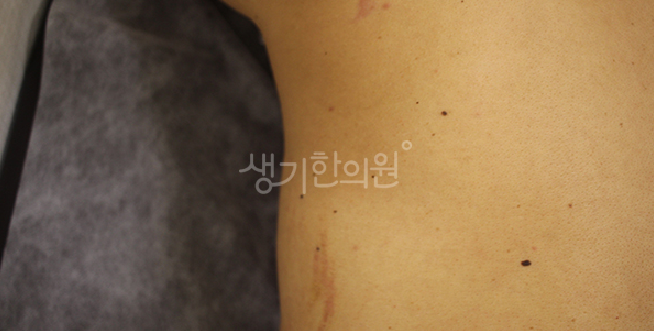 반복되는 두드러기, 오래 방치하게 되면 만성된다?