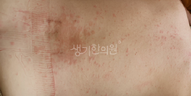 수원콜린성두드러기한의원 초기 치료가 중요하다?