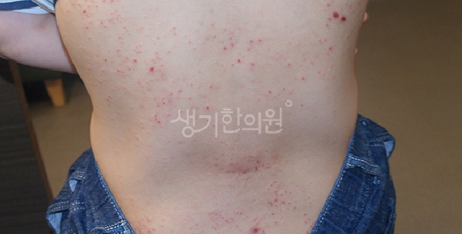 피부아토피 가려움 치료법 개인 체질 맞춤으로 해야