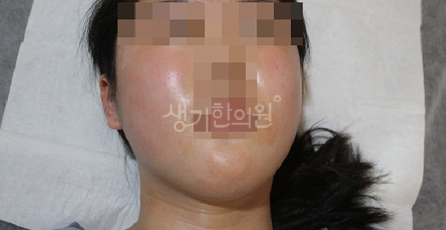 아토피 근본 원인을 치료해야 재발막는다?