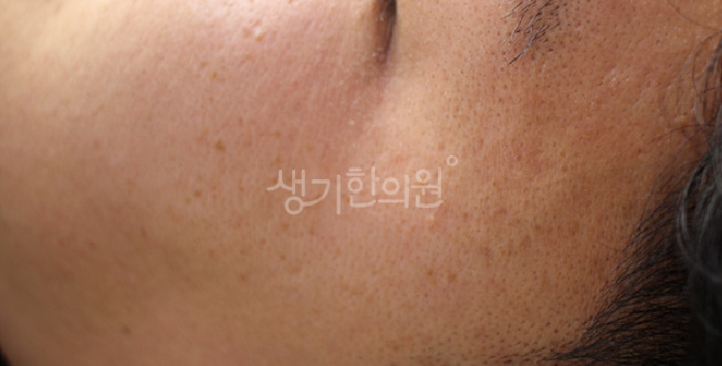 파주운정피부과증상 편평사마귀 올바른 관리법으로 실천하기