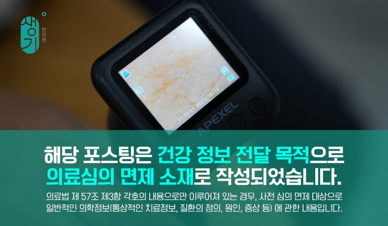 주부습진 스테로이드 연고 발라도 그대로라면