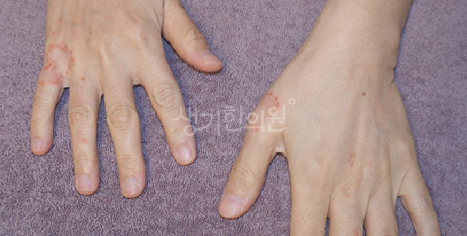주부습진 스테로이드 연고 발라도 그대로라면