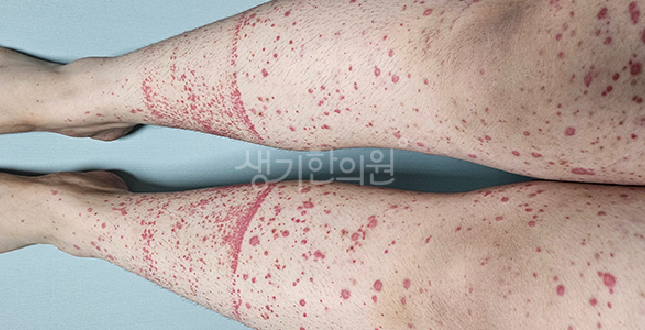 피부 붉은 반점 재발 낫다가 다시 생기는 고질적 원인은?