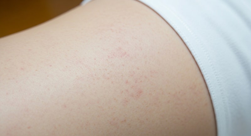 피부 붉은 반점 재발 낫다가 다시 생기는 고질적 원인은?