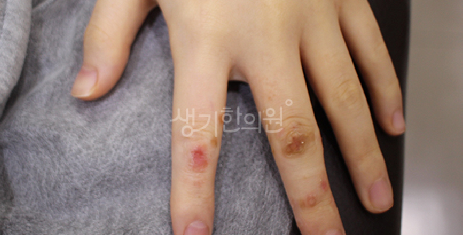 성인 물사마귀 전염된다 사실일까?