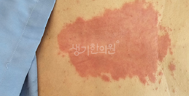 건선 면역 치료가 정말 효과 있을까?