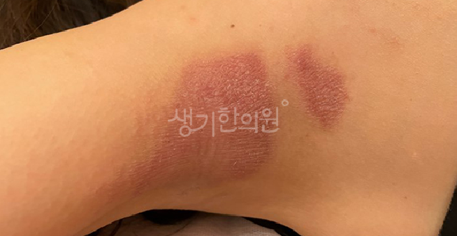 환절기 아토피 초기증상 가볍게 보고 넘기면 안돼
