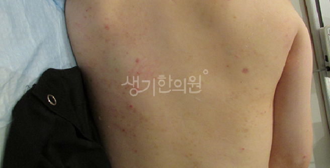 두드러기 원인 갑자기 온몸이 가렵고 부어오르는 이유