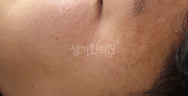 사우나나 때밀이 타월 사용을 금해야 하는 편평사마귀 피부 자극 주의점