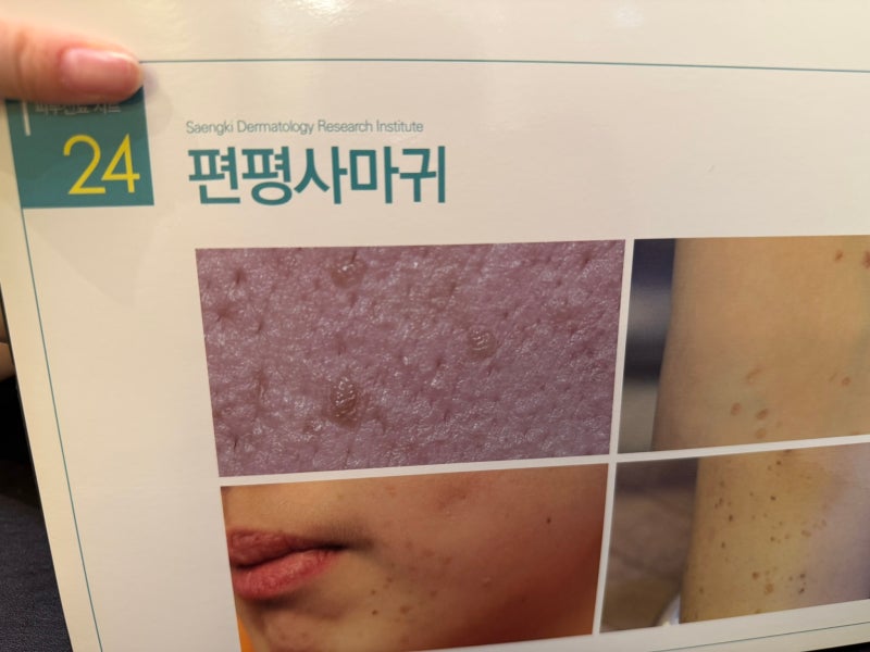 사우나나 때밀이 타월 사용을 금해야 하는 편평사마귀 피부 자극 주의점