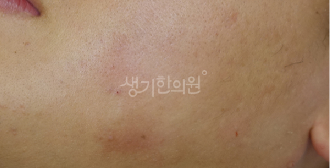 습진 가려움증 원인 밤마다 심해지는 수면 방해 요인 해결법