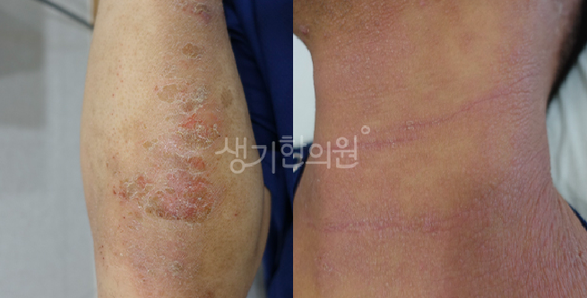 부산 동래피부과질환 아토피 유전 확률은?