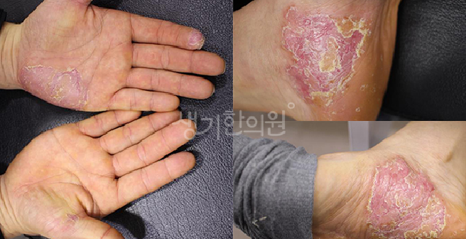 노인성 건선 특징 나이 들면서 감소하는 피부 유수분 밸런스 회복이 중요해