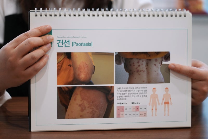노인성 건선 특징 나이 들면서 감소하는 피부 유수분 밸런스 회복이 중요해