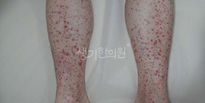자반증 예방 혈관 탄력 높이고 면역 독소 배출하는 방법