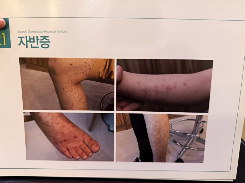 자반증 예방 혈관 탄력 높이고 면역 독소 배출하는 방법