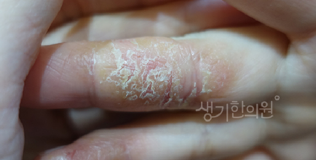 자율신경계 균형이 무너지면 악화되는 한포진 원인과 대책