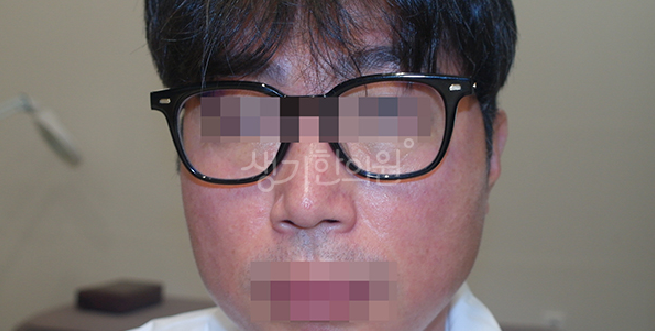 지속적인 자극으로 만성화된 안면홍조 치료 과정과 주의해야 할 점