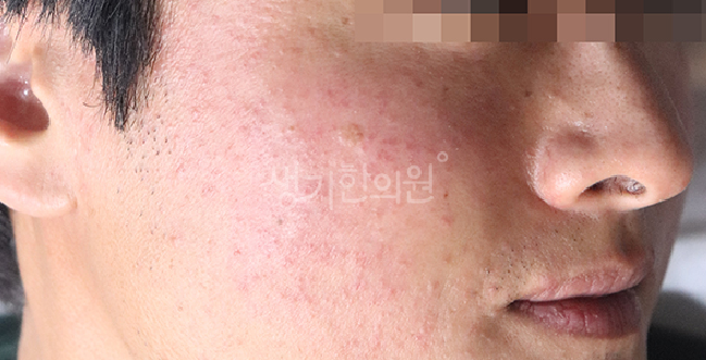 지루성피부염 세안법 피부 장벽을 깎아내지 않는 약산성 클렌징 노하우