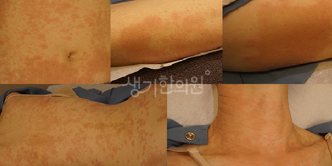 운동 후 콜린성두드러기 땀이 나면서 심해지는 팽진 완화법