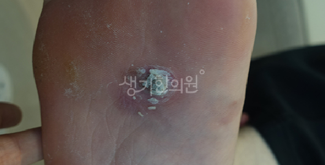 성인 사마귀 불규칙한 생활 습관과 만성 피로의 영향