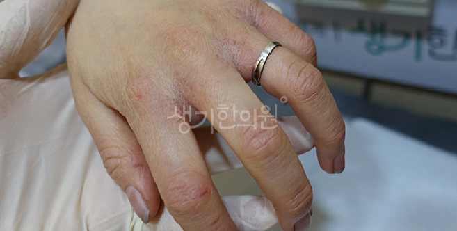 사이토카인 불균형으로 진물 날 때 급성기 피부 증상 자운고 발라도 괜찮을까?