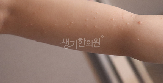 물사마귀 아기 피부 장벽이 약해 어린이집에서 옮아왔을 때 격리 및 대처법