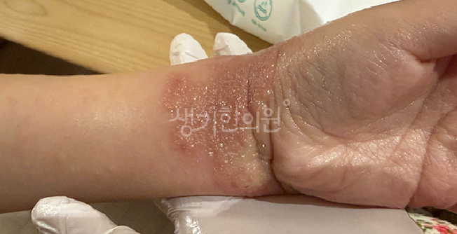 물사마귀 아기 피부 장벽이 약해 어린이집에서 옮아왔을 때 격리 및 대처법
