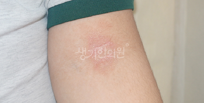 성인 습진 치료법, 단기 증상 완화와 장기 관리의 차이점은?