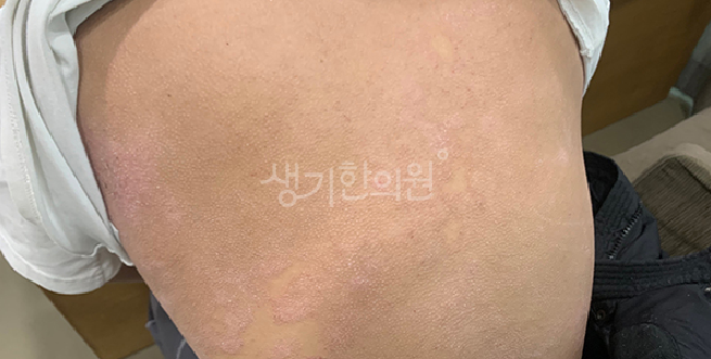 성인 아토피 치료 과정 면역 불균형을 바로잡고 무너진 장벽을 회복하는 법
