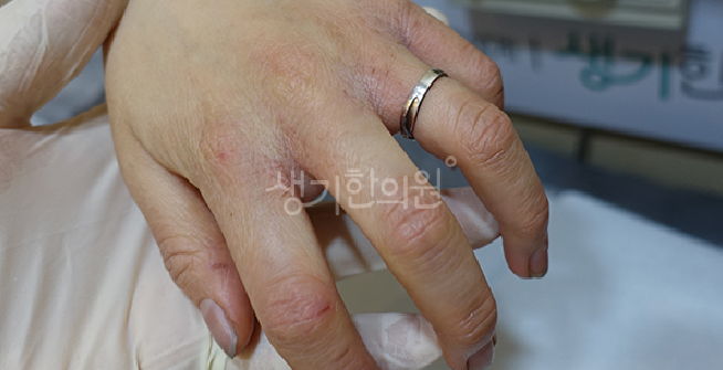 성인 아토피 치료 과정 면역 불균형을 바로잡고 무너진 장벽을 회복하는 법