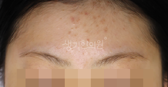 이마 여드름 치료 모자 착용 후 더 심해지는 악화 현상 예방하는 팁