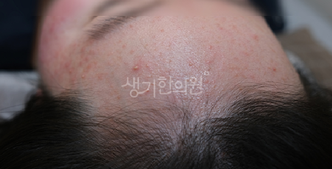 이마 여드름 치료 모자 착용 후 더 심해지는 악화 현상 예방하는 팁