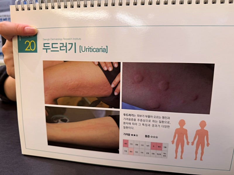 가려울수록 더 긁고 싶어지는 두드러기 소양감 악순환, 차단하는 현실적 방법