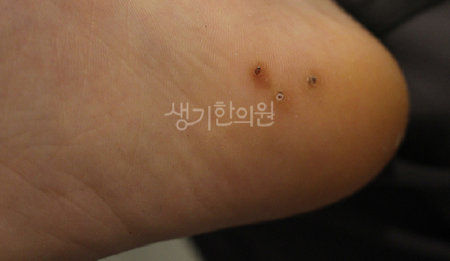 사마귀 증상 단계별 특징과 주변 피부 조직으로 번지기 전 대처하는 방법