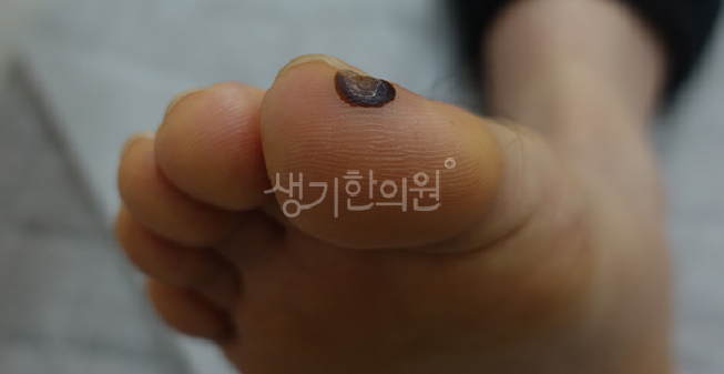 사마귀 증상 단계별 특징과 주변 피부 조직으로 번지기 전 대처하는 방법