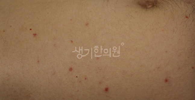 건선 초기 증상 체크리스트 확인해보세요.