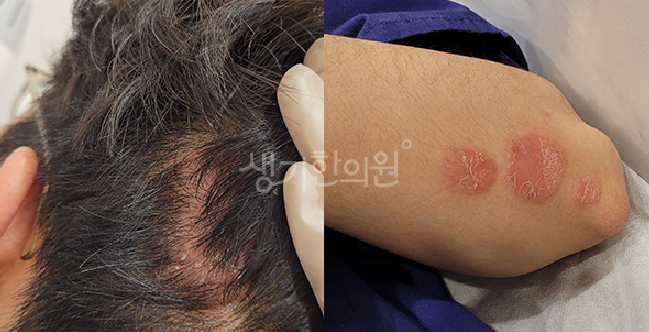 건선 초기 증상 체크리스트 확인해보세요.